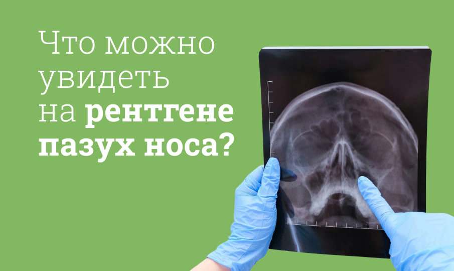 Рентген пазух носа