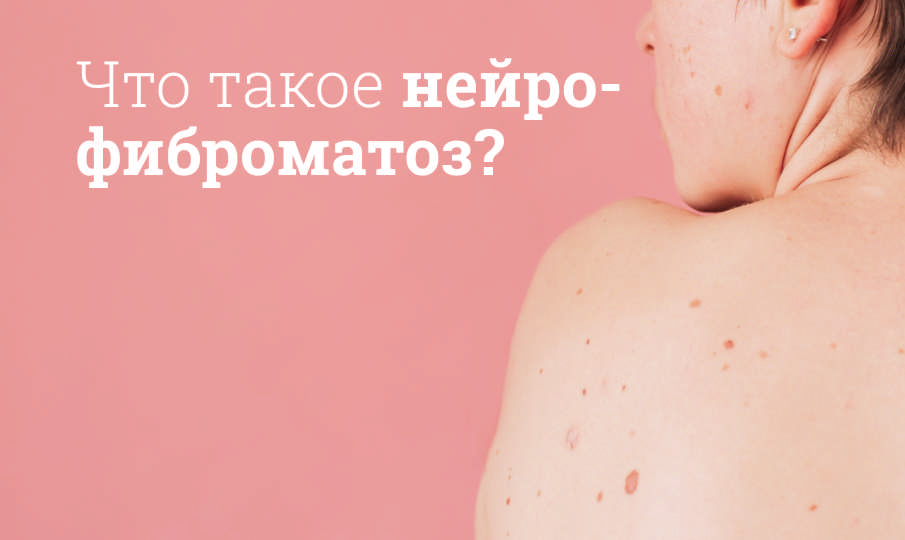 Симптомы нейрофиброматоза