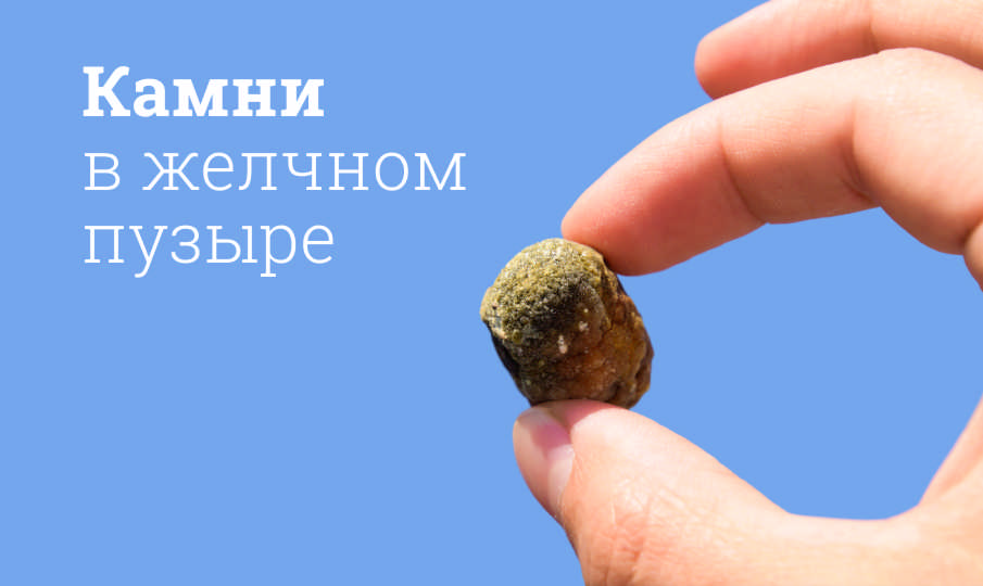 Камни в желчном пузыре: причины, симптомы, лечение