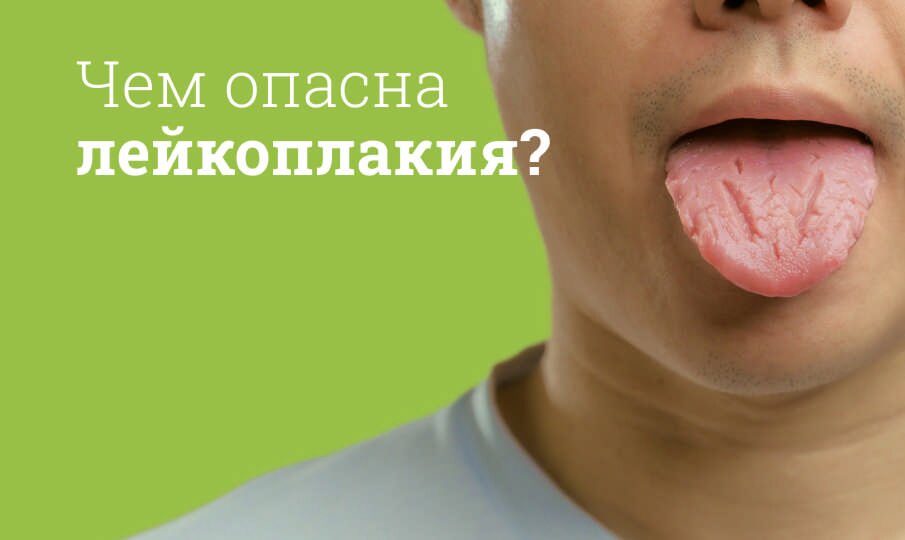 Лейкоплакия: лечение и симптомы
