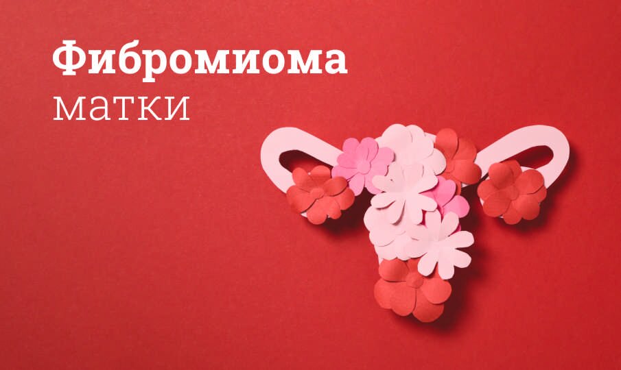 Фибромиома матки: симптомы и лечение