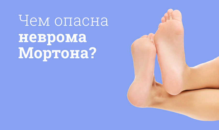 Неврома Мортона