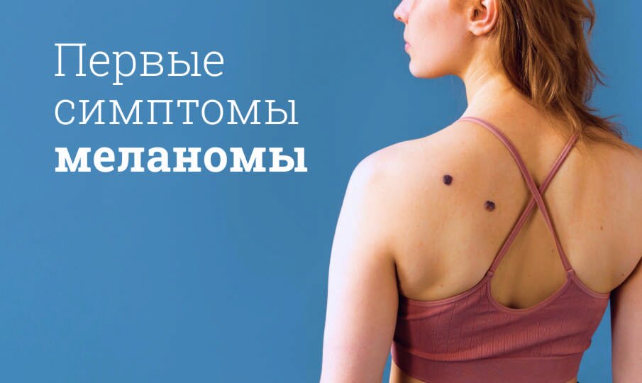 Меланома кожи
