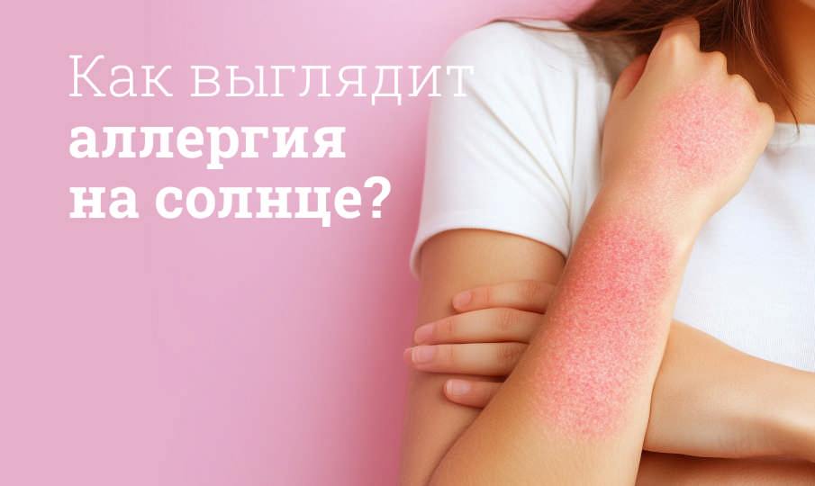 Как выглядит аллергия на солнце?