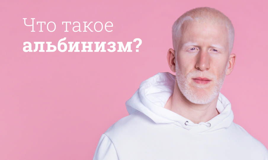 Признаки альбинизма