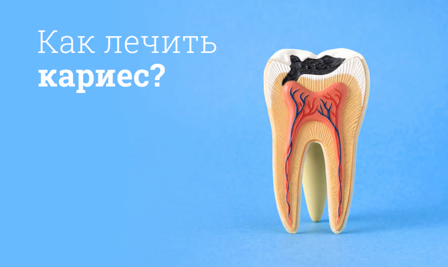 Лечение кариеса