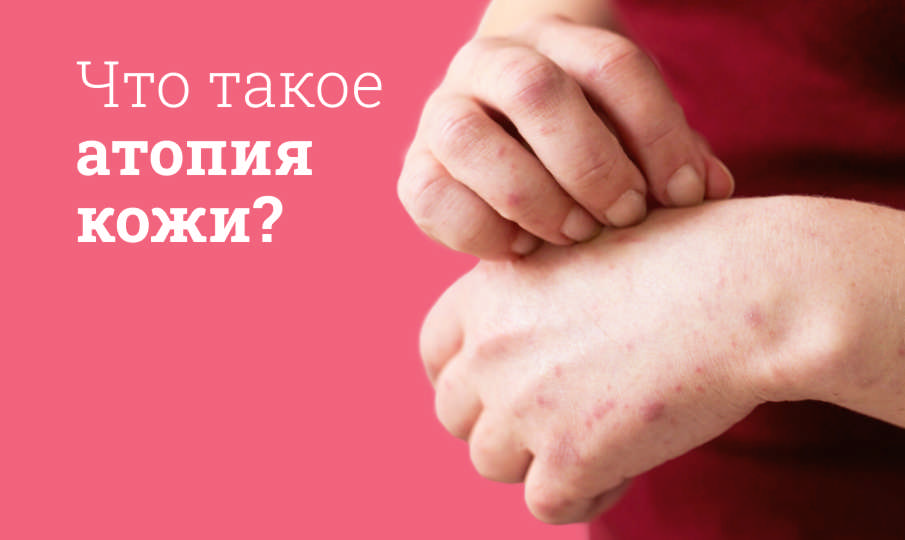 Что такое атопия кожи?