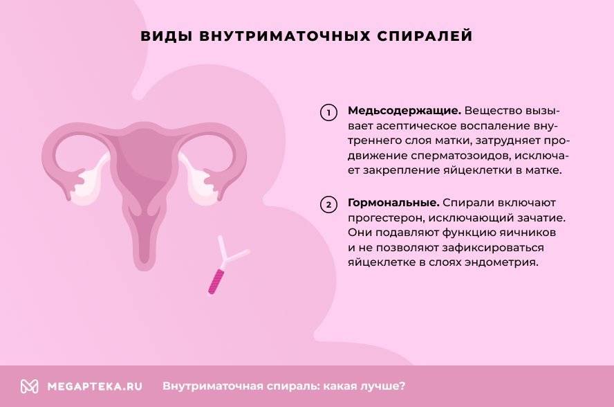 Внутриматочная спираль – все об этом виде контрацепции | Статья