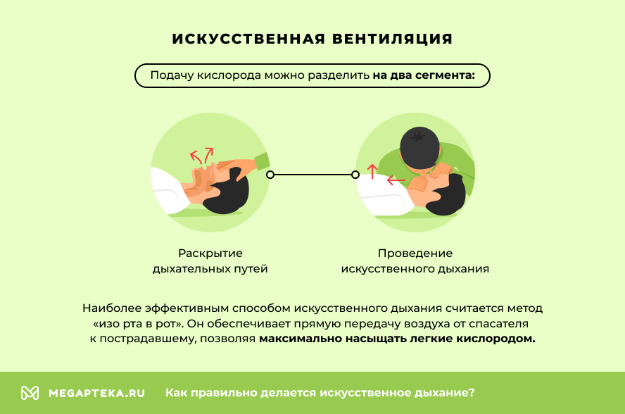 Искусственная вентиляция