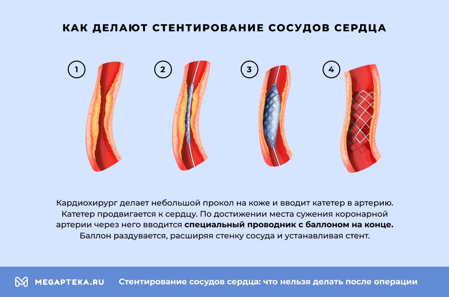 Как делают стентирование сосудов сердца