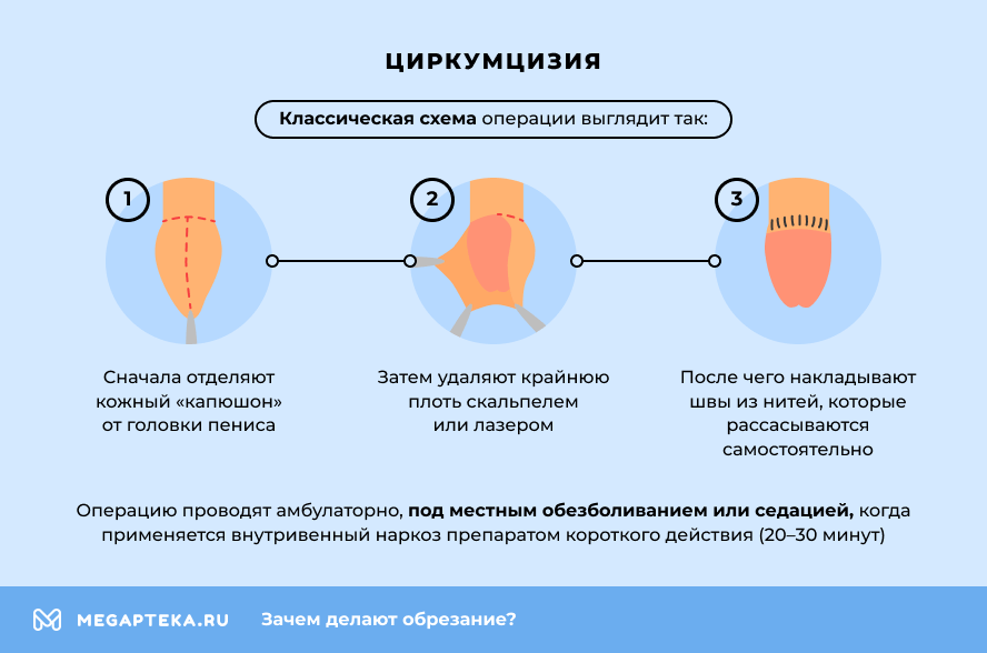 Циркумцизия