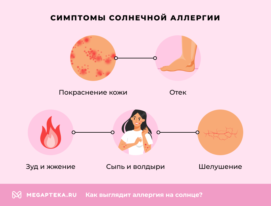 Симптомы солнечной аллергии