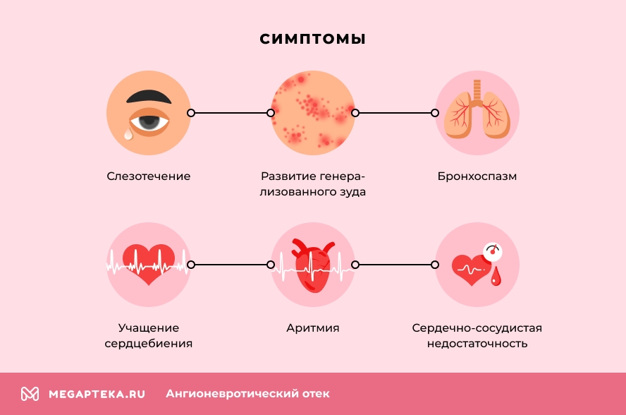 Отёк Квинке (ангионевротический отёк) - что делать, причины, симптомы и лечение