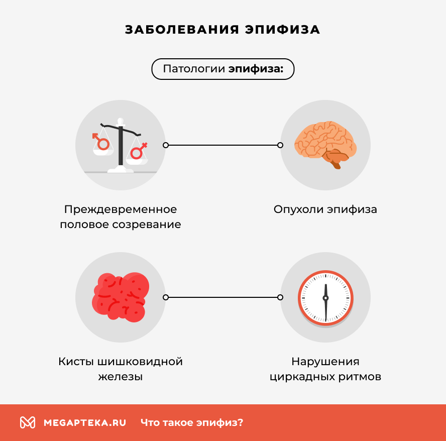 Заболевания эпифиза