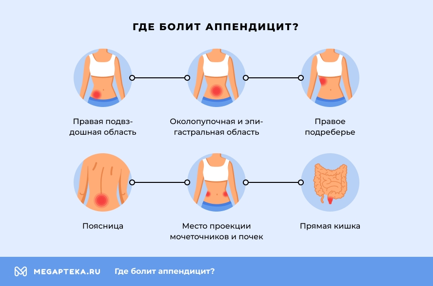Где болит аппендицит?