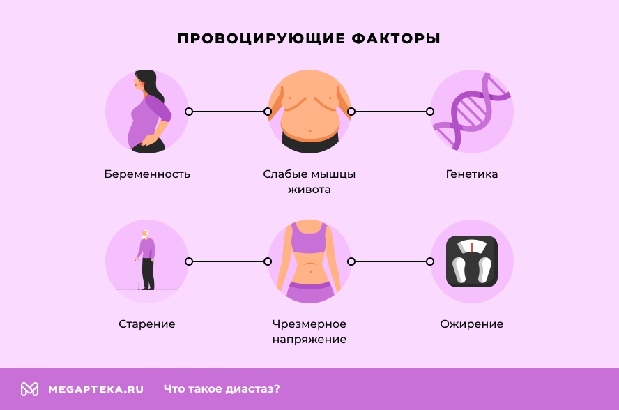 Диастаз: симптомы, лечение, упражнения