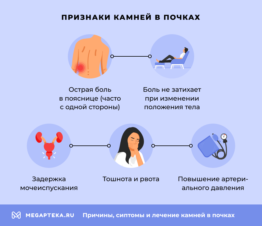 Признаки камней в почках