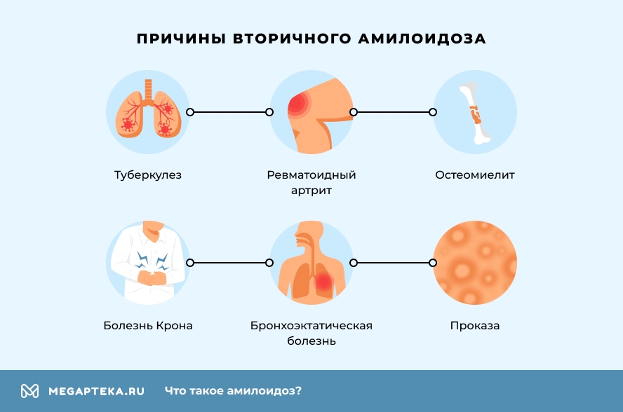 Причины вторичного амилоидоза. Причины вторичного амилоидоза