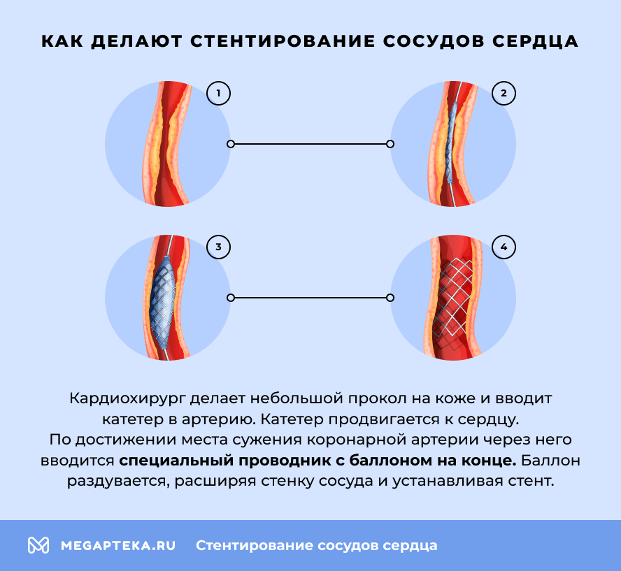 Как делают стентирование сосудов сердца