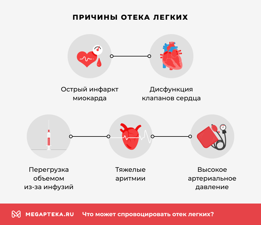 Причины отека легких