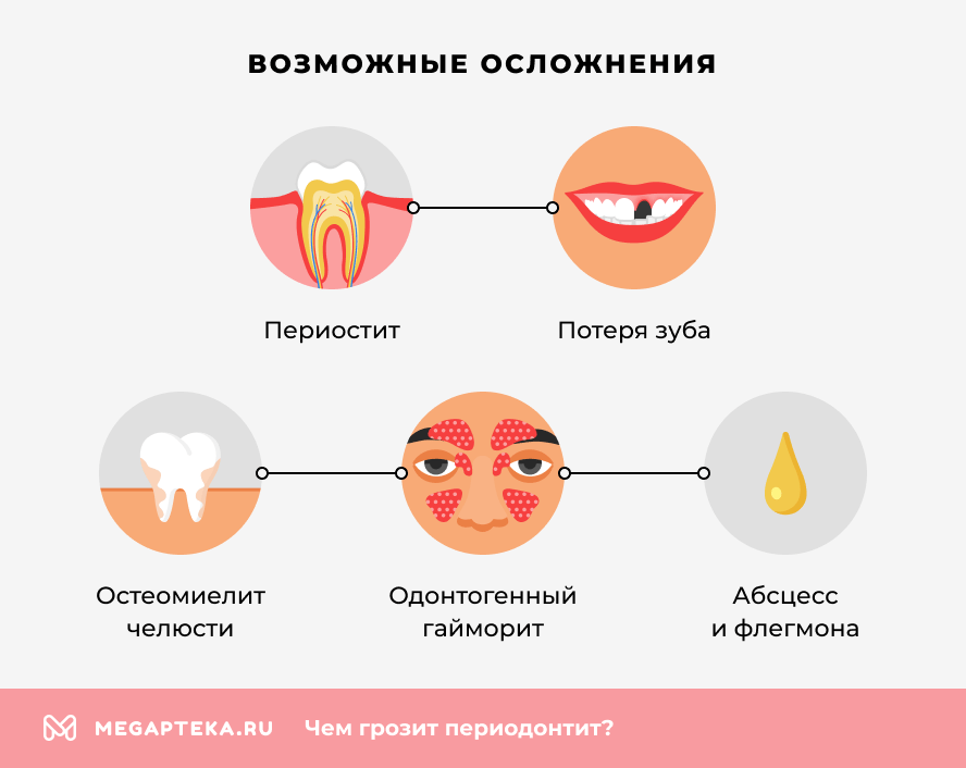 Чем грозит периодонтит?