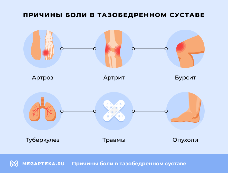Почему болит тазобедренный сустав?