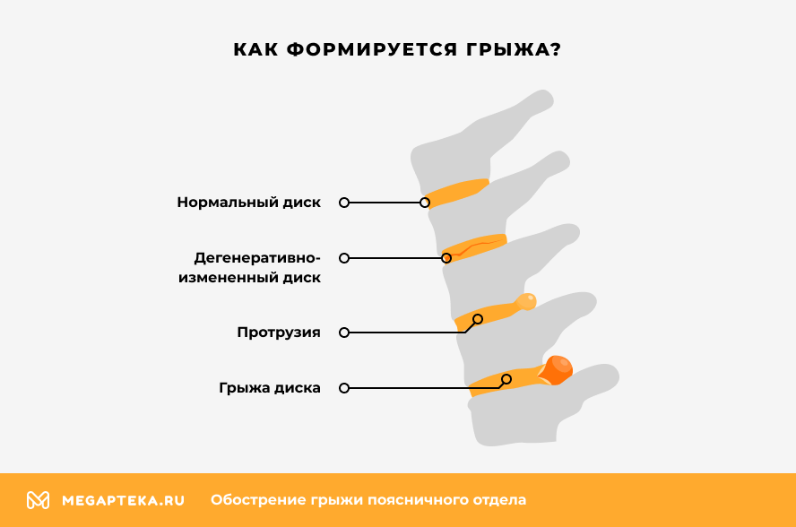Как формируется грыжа?