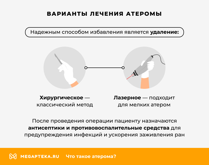 Варианты лечения атеромы