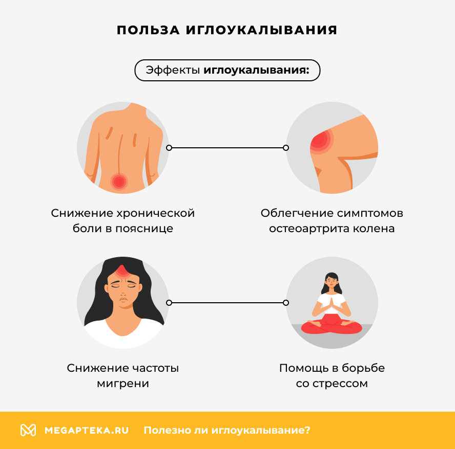 Польза иглоукалывания