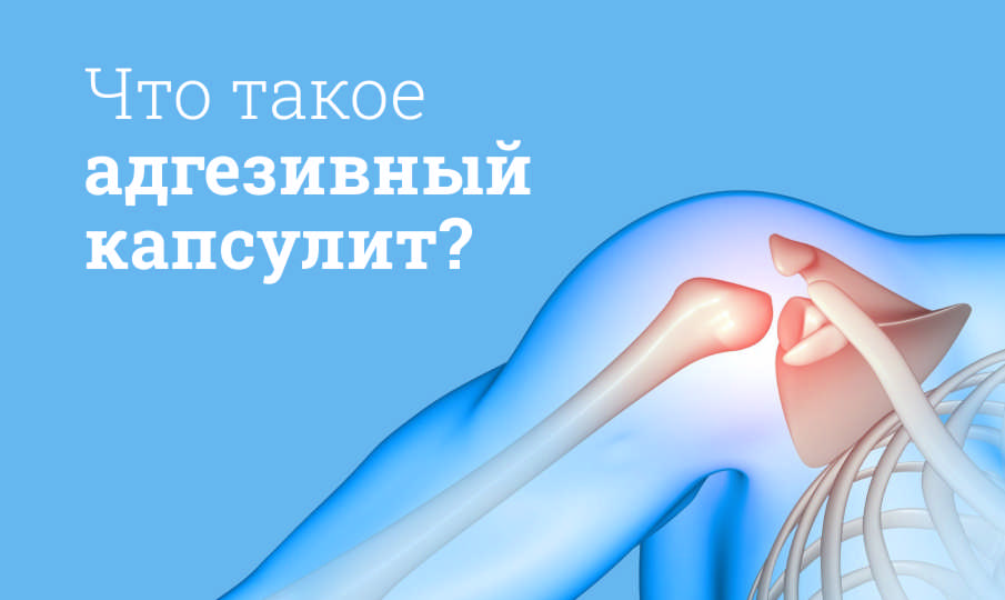 Что такое адгезивный капсулит?