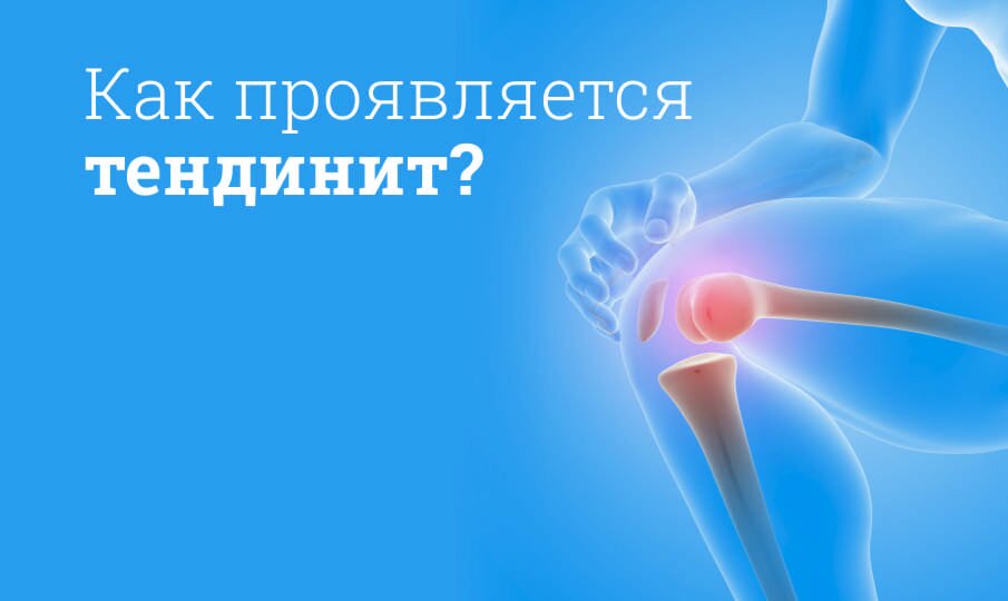 Тендинит: симптомы и лечение