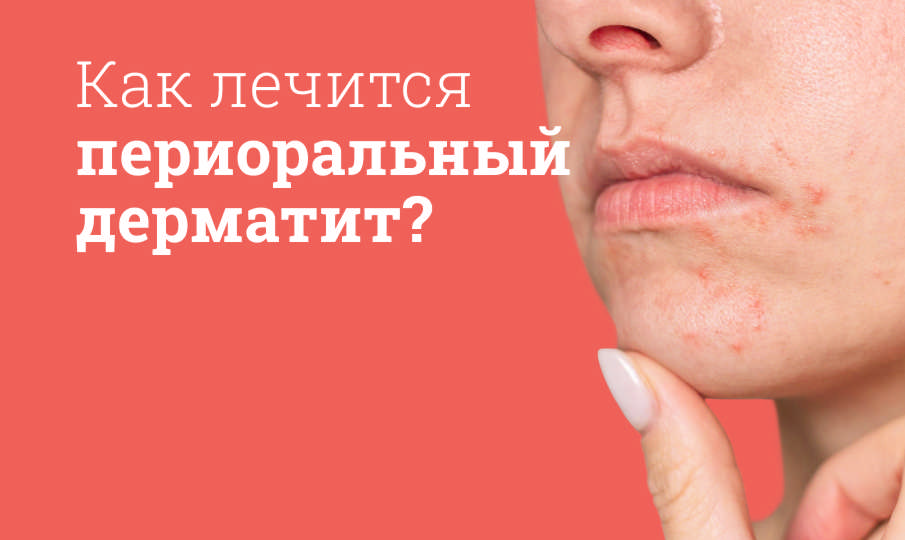 Периоральный дерматит на лице