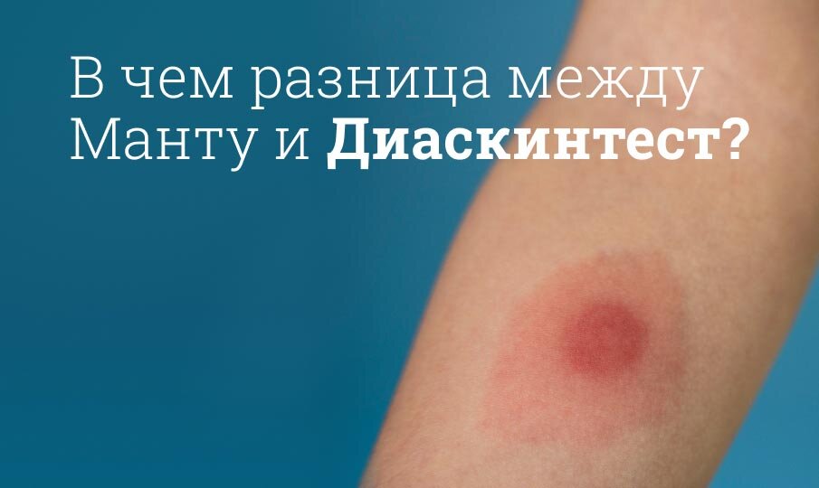 Прививка Диаскинтест