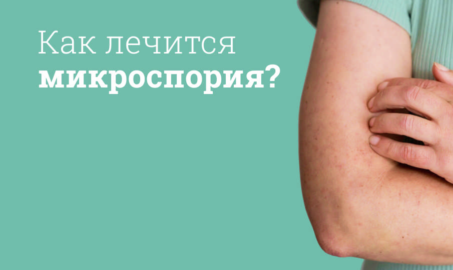 Лечение микроспории