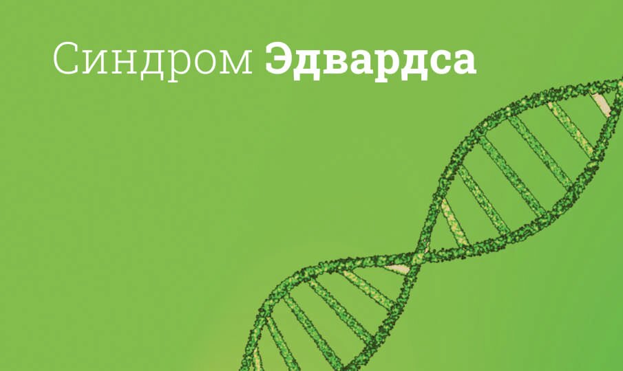 Синдром Эдвардса: симптомы и признаки