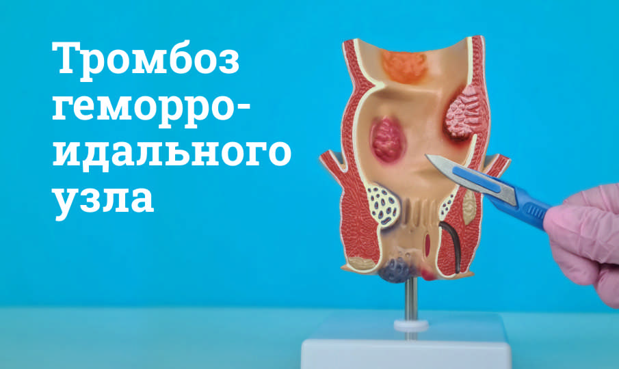 Тромбоз геморроидального узла
