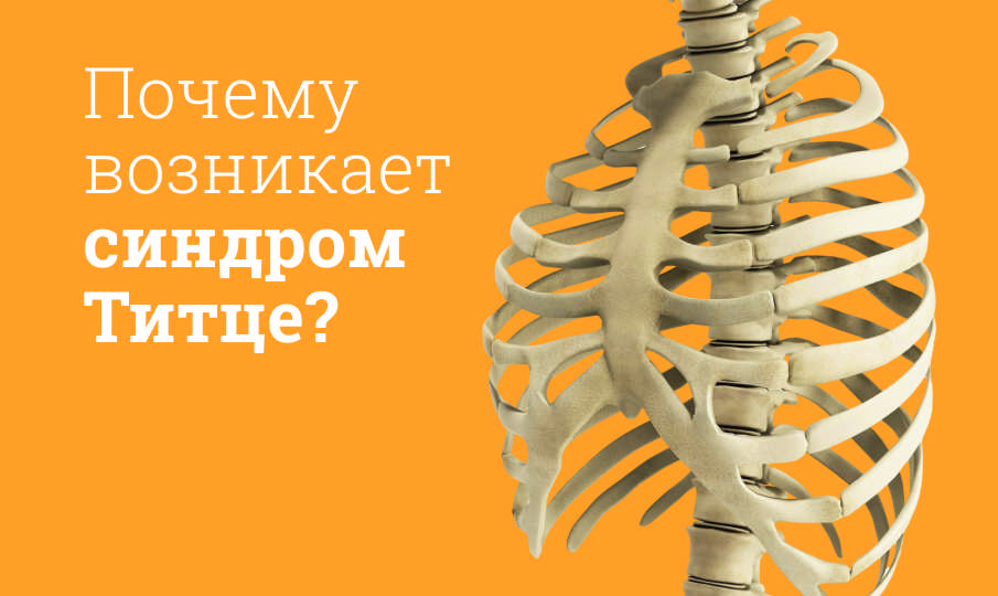 Синдром Титце