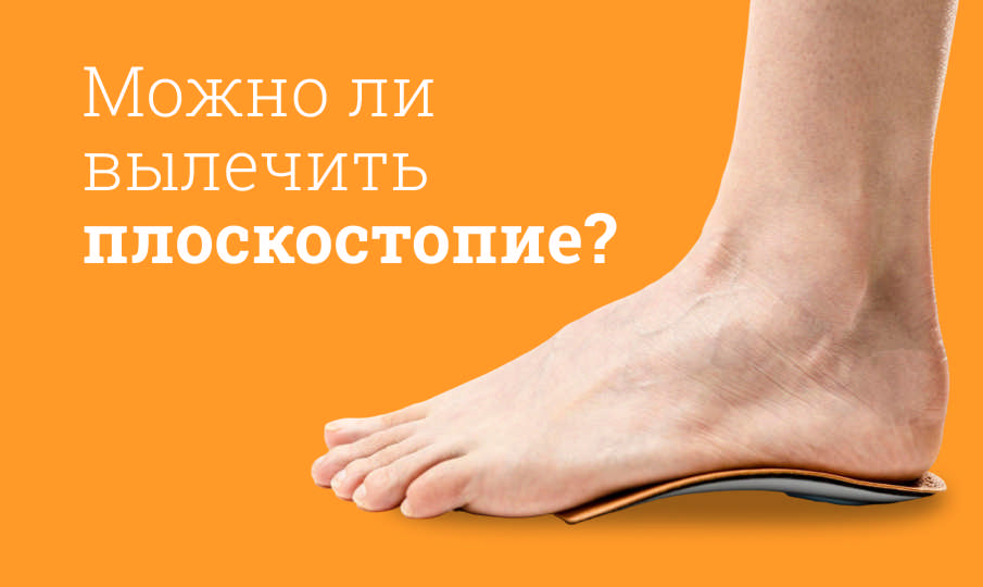 Степени плоскостопия