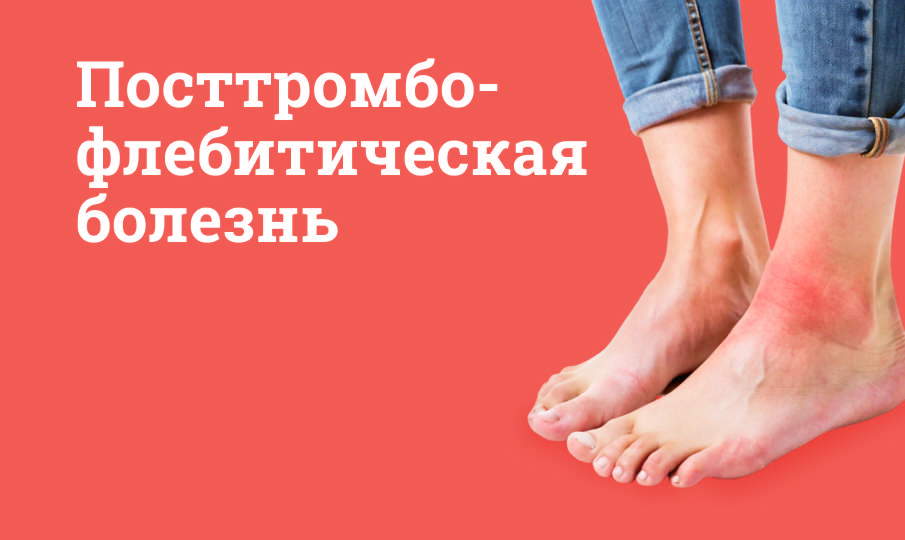 Посттромбофлебитическая болезнь